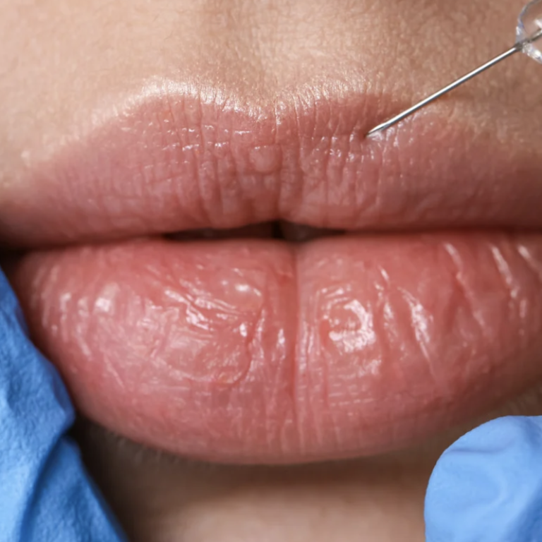 Lip Filler Specials and Free Consultations Near Mclean Virginia